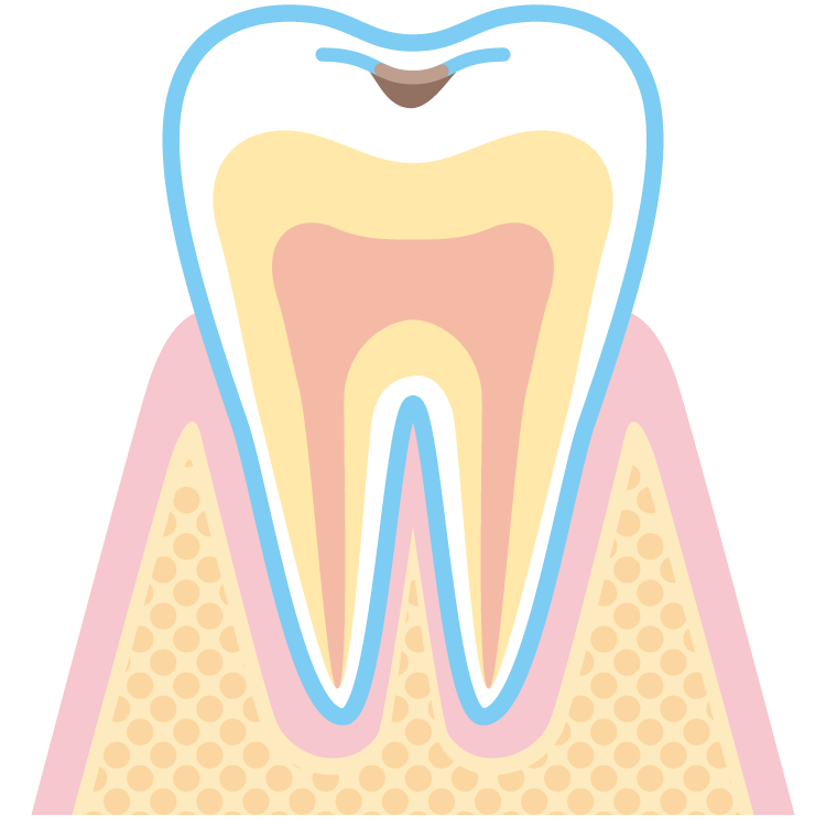 虫歯・初期（C1）のイメージ