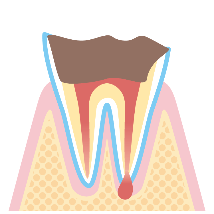 虫歯・末期（C4）のイメージ